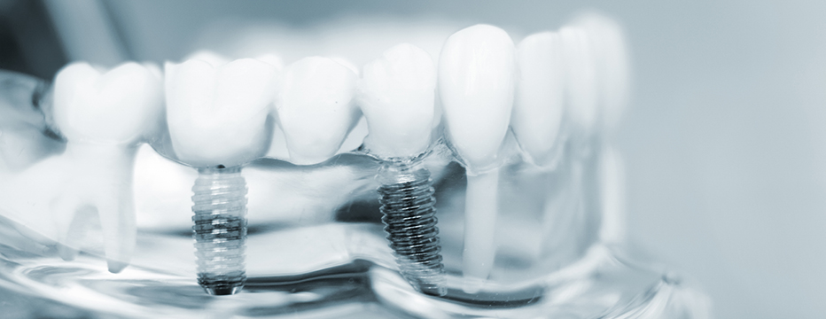 Implantologie et greffe osseuse
